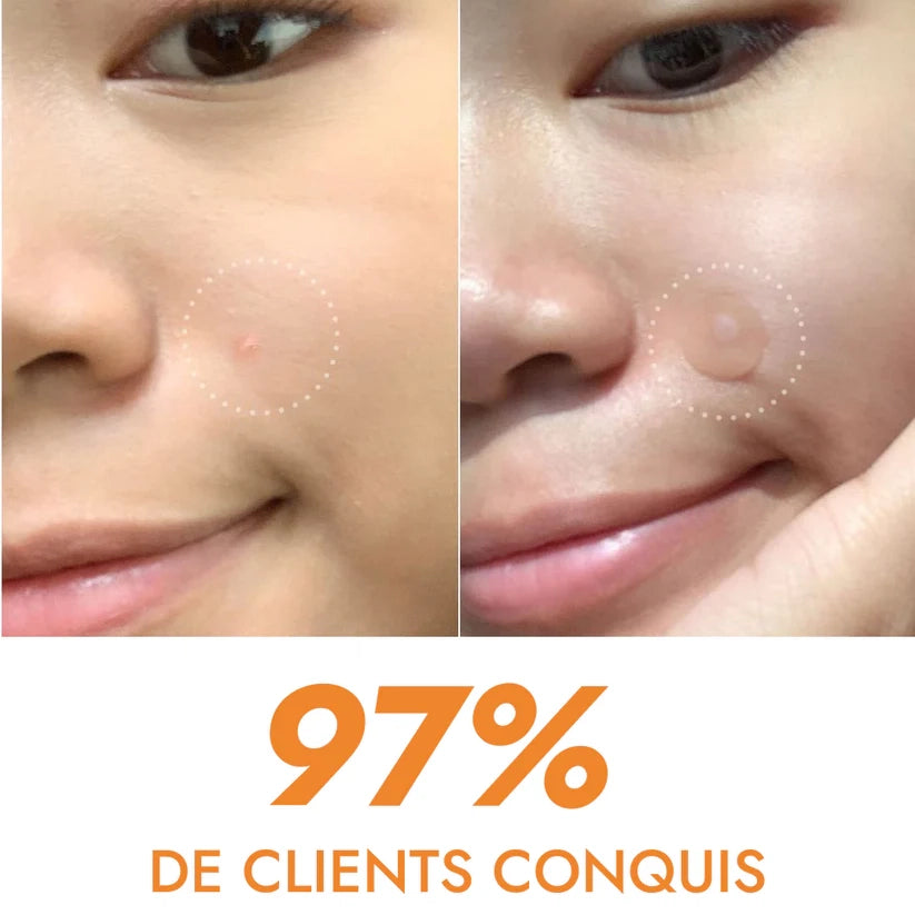 Patchs anti boutons et acné